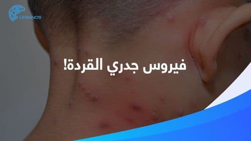 جدري القردة: ما هي عوارضه؟ وهل وصل إلى لبنان؟